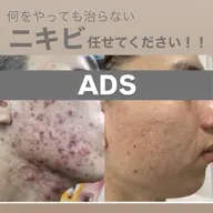 ニキビ（白・黒ニキビ）【角質ケア+抗炎症・高保湿美容液導入+肌質別パック】で鎮静×修復×エイジングが一緒に叶う♥