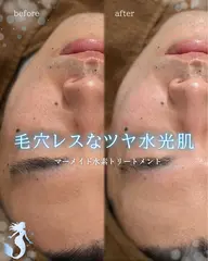 【乾燥,毛穴開き,ハリ,ツヤ】マーメイド水素トリートメント🧜🏻♀️🫧肌水分量UPでもちもちツヤツヤ水光肌に🩵✨