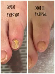 足元の菌トラブルに徹底アプローチ✨ 清潔感を取り戻す“菌バスターケア”