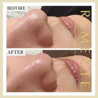 【✨口コミ記載の方体験半額！✨】★期間限定★毛穴の汚れを一掃✨ハイドラフェイシャル（毛穴洗浄）‼️ニキビや黒ずみに効果