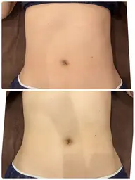 特許取得キャビゼロ☆理想のボディラインへ😊１部位（２０分コース）