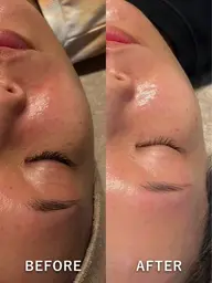 【シミそばかす改善⚡️】光フェイシャル