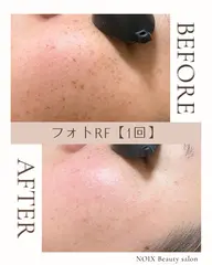 美顔フォトRF💎シミ・毛穴ニキビ跡ケア＋美肌パックで肌育×透明感✨