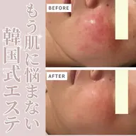 🔥本気で肌改善したい方向け【ニキビ跡・毛穴開き】ララピール✖️最強導入機