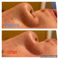 ✨毛穴集中フェイシャル✨　60分