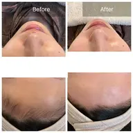 お顔に優しいマツヤニフリーフェイスワックス＋炭酸ガスパック