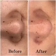 【🌟毛穴汚れザラつき僕滅メニュー🌟】全顔毛穴洗浄＋ハイドロジェリーマスク