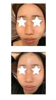 肌質改善ニキビ:毛穴:トラブル肌に悩む方に⭐︎イオン導入ビタミンC60分