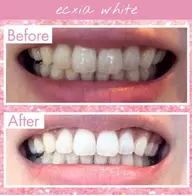 【平日限定/16時迄】セルフホワイトニング(9分2セット)1回 ¥500 別途料金なし