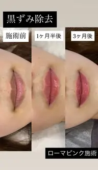 🩷人気沸騰中のローマピンク🩷まずはカウンセリングにどうぞ🫧