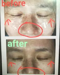 大人気♪最新BBL光フェイシャル☆もちもちお肌　¥18000→¥5500