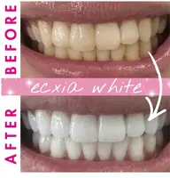 【定額★通い放題】セルフホワイトニング¥11000/円