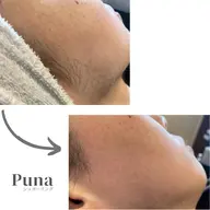 女性【シュガーリング】フェイス脱毛（保湿パック付）全顔