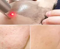 【毛穴特化ケア】Ygレーザ×特殊炭素で詰まり毛穴、開き毛穴ケア ※ダウンタイム無