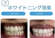 【ミニモ学割1日完結型ホワイトニング歯の黄ばみ1日で解決】ワンデーホワイトニング　歯を1日でスグ白くしたい方オススメ