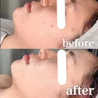 《同時施術可能🤍》最新ハーブピーリング×ララピール✨️渡韓せずに一気に美肌に