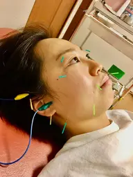 🍀新規ミニモ限定🍀 美容鍼×美顔整体(ドライヘッドスパ)ニキビ、肌荒れ、小顔、リフトアップ、エラ張り、潤い回復に❤️