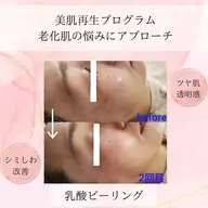 ✨乳酸ピーリング＋GF細胞増殖因子導入✨ワントーンアップ　ツヤ肌　一度で体感⤴️ 毛穴　シワ　たるみ改善！トラブル肌改善