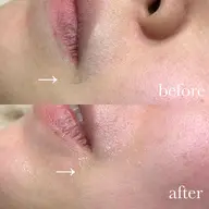 フェイシャルワックス脱毛