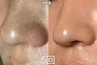 【モニター】水素ピーリング＋プラズマニードル＋エクソソムフェイシャル