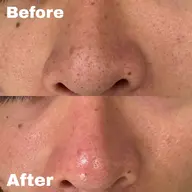 【毛穴撃退】クイック毛穴洗浄＋お顔のむくみ&たるみケアコース