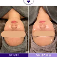 【ミニモ限定】 🍋圧倒的透明感/高濃度ビタミンC30％導入🍋クリスティーナ　ホワイトピーリング　60分