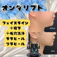 オンダリフト25分｜フェイスライン顎下80kj~140kj＋鼻の毛穴洗浄＋ララピールorプラピール