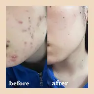 【💛卒業式前💛】肌トラブル改善エステ*ホームケア1週間分プレゼント🎁