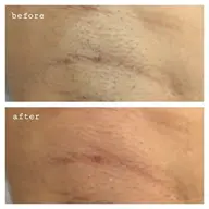 メンズ脱毛❇️腕・足セット　シェービング付き