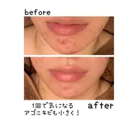 90分11000円❣️ご褒美エステ❤️乾燥撃退❣️温泉由来の蜜蝋パック♨️ 首＊肩＊デコルテマッサージでコリほぐし✨