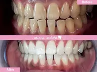 【4/16.17限定★】口内管理★セルフホワイトニング(9分×2回)1回(追加料金無し)3,980円→