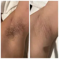 【メンズ脱毛】選べる!脇or手の甲指脱毛 ¥1,980