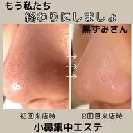 ✨得々3回コース✨現金払い限定💰毛穴が気になる方におすすめ♡小鼻すっきりエステ