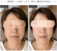 本気の肌質改善🌿肌生まれ変わりGREEN PEEL 【5days】