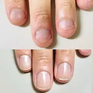 深爪矯正 幼い頃からの噛み癖やむしり癖による深爪を縦長爪へ。オイル1本プレゼント