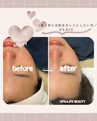 【１番人気☆お肌をキレイにしたい方】剥離なしピーリング30分コース￥5,610