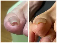 【巻き爪】親指1本