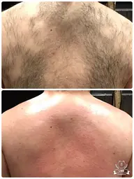 メンズLLパーツ【脚全体、腕全体、背面全体、前面全体のいずれか1パーツ】美肌脱毛