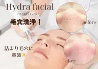 【毛穴すっきり洗浄】ハイドラフェイシャル