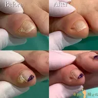 【副爪ケア2指】小指の爪横にある爪みたいなモノ💡キレイに除去し、痛みや違和感を解放💁♀️