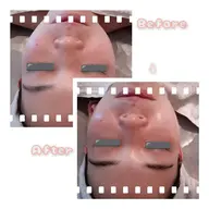 シミ跡、ニキビ跡などお肌の用途により良くしていきたい方はこちら☆剥離しないハーブピーリング+オーガニックフルフェイス♡