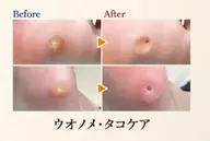 【魚の目ケア】足裏ゴワゴワ角質や痛​〜​い魚の目をキレイに取り除きスベスベの足裏へ✨