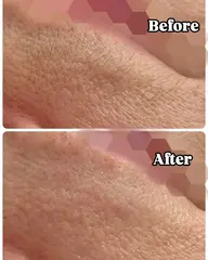 つるん肌ෆ ̖́-フェイスワックス脱毛