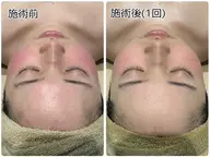 【ますばお試し】ヒト幹細胞💎メディカルハーブピーリング🌿✨(剥離なし)