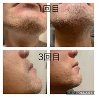 ヒゲ脱毛(男性)