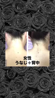 うなじ背中脱毛
