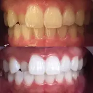 ☆minimo限定☆ホワイトニング体験ロングコース🦷！