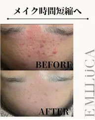 【剥離あり】顔🌿ハーブピーリング