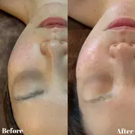 【美白・トーンアップ◎】REVIハーブピーリング