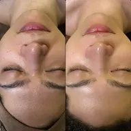 【男女🆗】ハイドラシャイン＋プラズマ⚡️水流のチカラで毛穴汚れオフ➕シミケア✨ 毛穴洗浄/小鼻の黒ずみに💆‍♀️